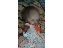 Clarisa Bayi Kembar Penderita Hidrosefalus Butuh “Uluran Tangan”