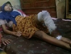 Kaki Membusuk dan Keluar Belatung, Mita Butuh Bantuan